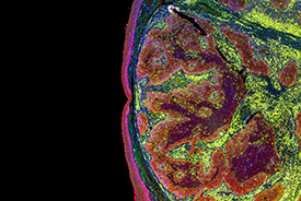 brain tumour scan