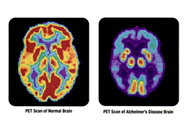 PET scans of a healthy brain and one suffering from Alzherimer's.