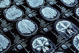 brain mri scan