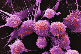 Prostate cancer cells