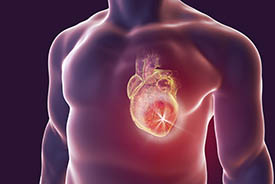 Heart attack