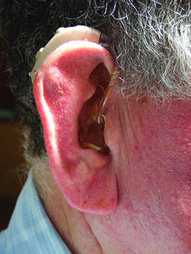021 Hearing impaired man with hearing aid web