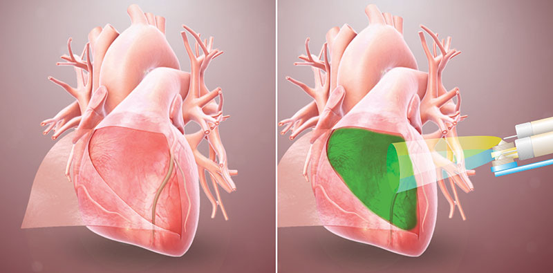 A hydrogel that forms a barrier to keep heart tissue from adhering to surrounding tissue after surgery was developed and successfully tested in rodents by a team of University of California San Diego 