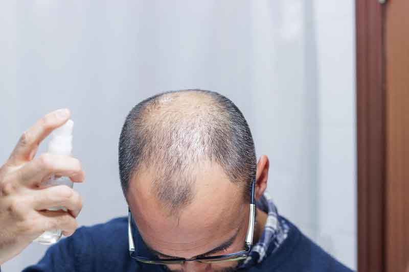 Man using spray on his balding head