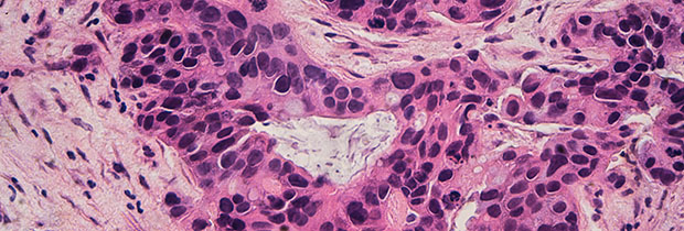 breast cancer cells