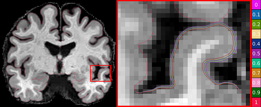 CSIRO researchers are using machine learning to advance Alzheimer’s research