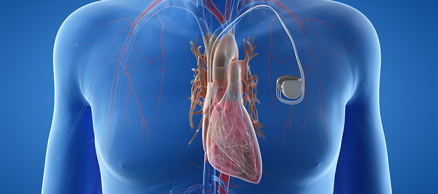 SCIBlog - 14 December 2022 - graphic showing pacemaker on body