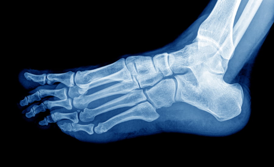 SCIBlog - 13 September 2022 - image of foot X-Ray