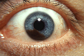 ”Uveal melanoma”